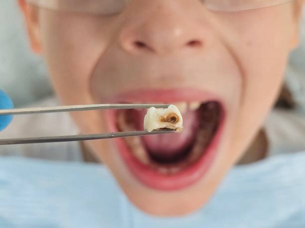 Best Broken or Cracked Tooth Emergency Dentist in Custer, SD
